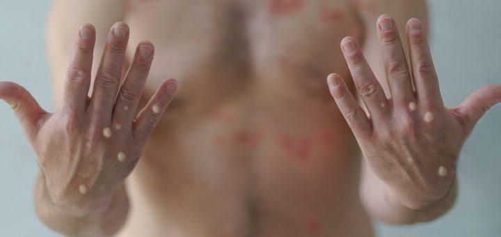 what is monkeypox